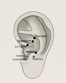耳穴电针治疗妊娠期糖尿病1例报告